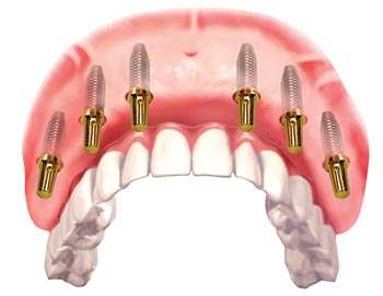 Full Arch Implants Carmel, IN - Smiles in the Village Dentistry