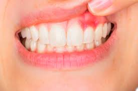 Gum Health Awareness Signs of Gingivitis You Shouldn’t Ignore