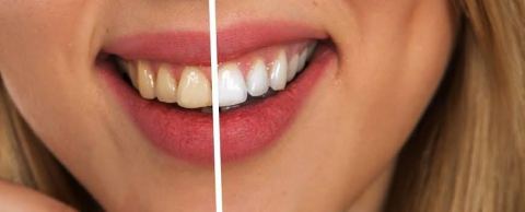 Cosmetic Dentist in Carmel, IN