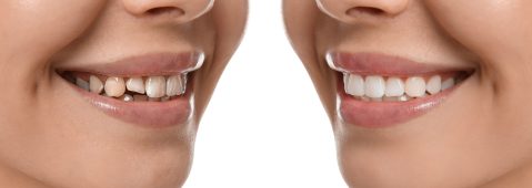 How Dental Crowns Restore Damaged Teeth and Protect Your Smile