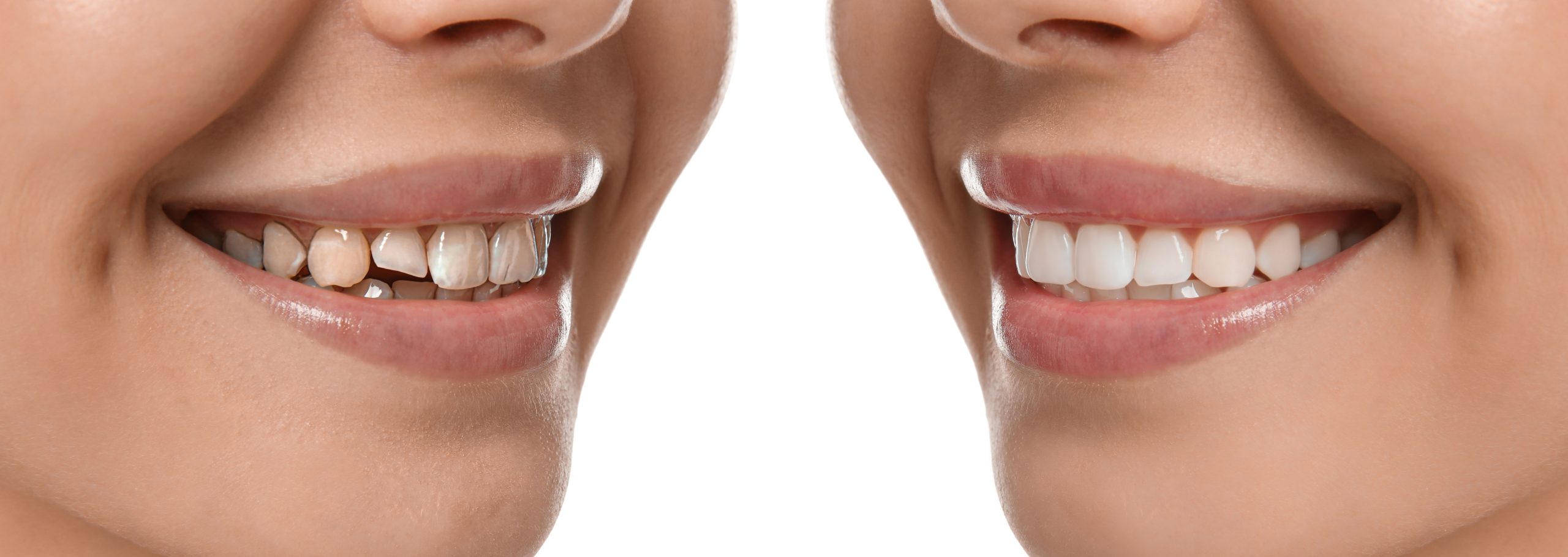 Dental Crowns In Carmel, IN: Same‑Day Solutions & Lasting Smile Protection