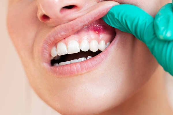 The Stages Of Gum Disease And When To Seek Treatment