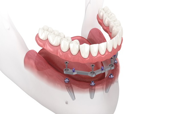 A Brief Comparison Between Implant Supported Dentures And Traditional Dentures